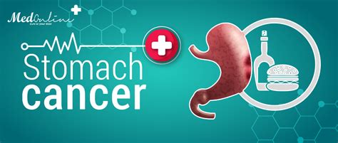 Stomach Cancer Causes Treatments And Prevention Medonlinepk