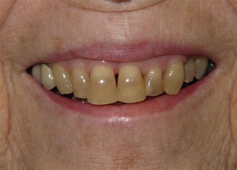Dental Whitening Smile Gallery Raber Dental Kidron Dentist