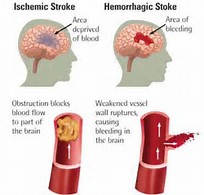 Image result for ischemic stroke