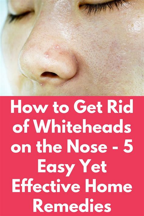 How To Get Rid Of Whiteheads On The Nose 5 Easy Yet Effective Home