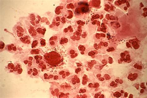 Trichomoniasis Causes Symptoms Pictures Treatment Std Diseases