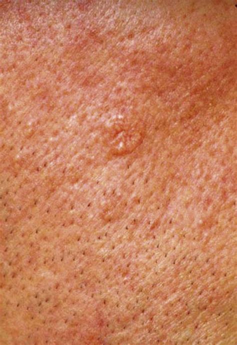 Photos Of Non Cancerous Skin Lesions Cancerwalls