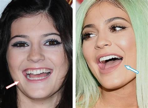 Taylor Swift Teeth Before And After Veneers
