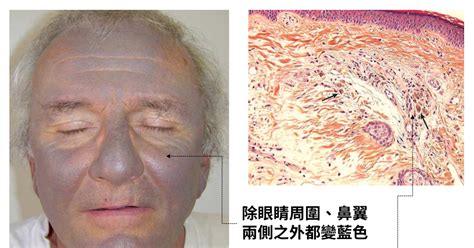 臨床病例 Amiodarone引起的皮膚色素沉著 Blue Gray Hyperpigmentation After Amiodarone