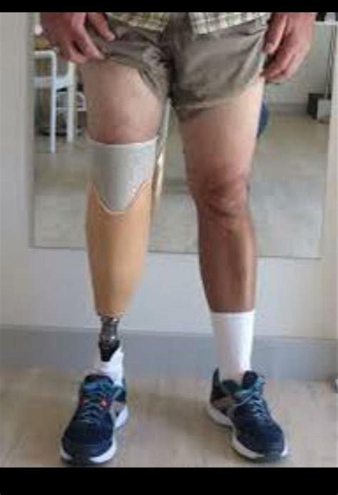 Bionic Functional Prosthetic Below Knee Prosthesis With Joint