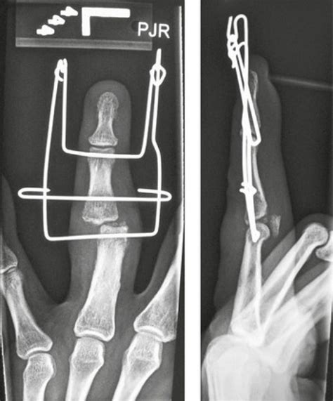 3 Fracture Fixation Radiology Key