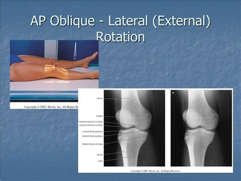 Knee Oblique External X Ray Polymed Lab