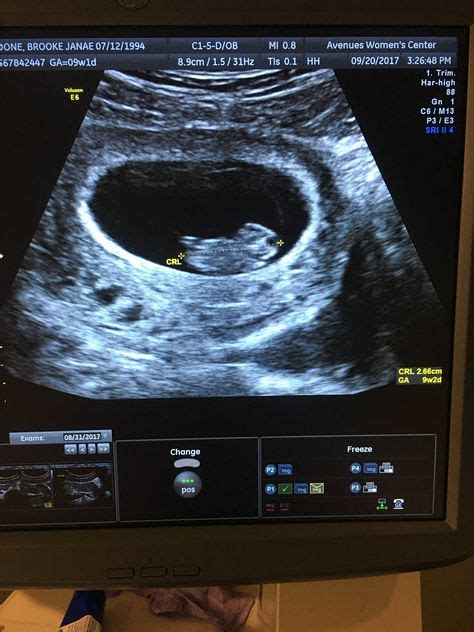 3 Weeks Pregnant Ultrasound