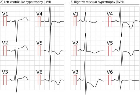 Ecg In Left Ventricular Hypertrophy Lvh Criteria And Implications