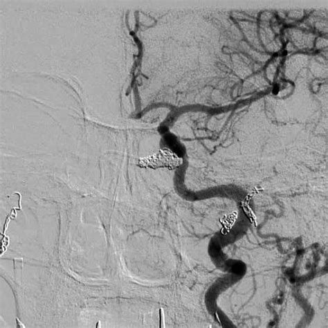 Cerebral Angiography During The Embolization Procedure Using