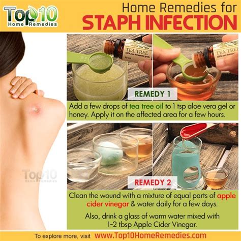 Staph Infection Prevention And Home Remedies Top 10 Home Remedies