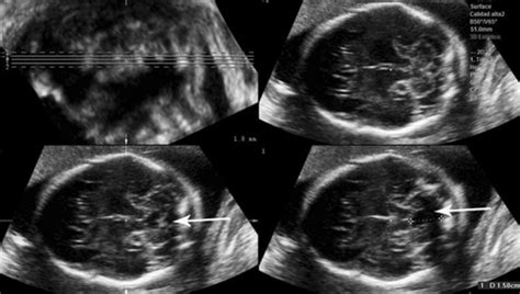 First‐trimester Sonographic Findings Associated With A Dandy‐walker