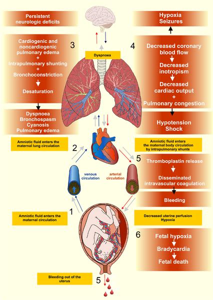 Medivisuals Pathophysiology Of Amniotic Fluid Embolism Medical Illustration Hot Sex Picture