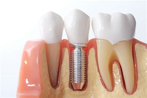 Dental Implants What You Need To Know About Single And Multi Tooth Replacement Richard