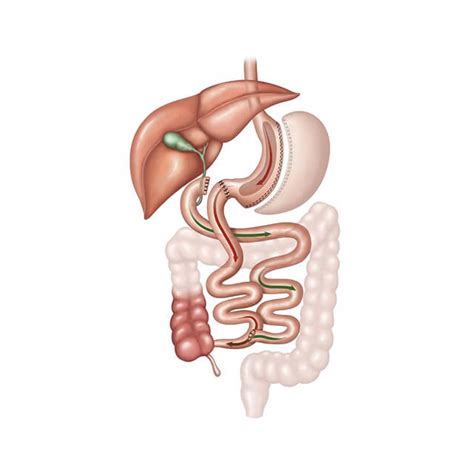 Laparoscopic Duodenal Switch Chicago Rami Lutfi Md Facs