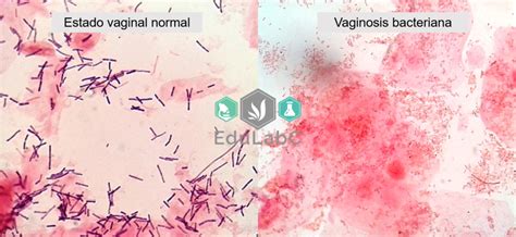 Vaginosis Bacteriana Edulabc