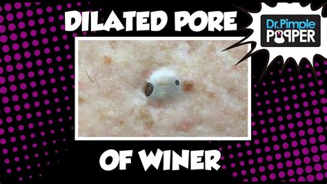 Dilated Pore Of Winer Giant Blackhead Youtube
