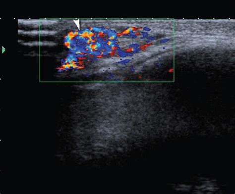 Hemangioma Color Doppler Image Reveals A Highly Vascular Mass