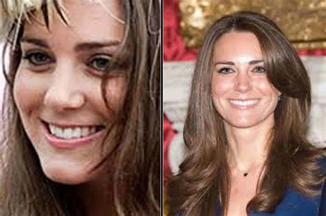 Kate Middleton Before And After Plastic Surgery 13 Celebrity Plastic