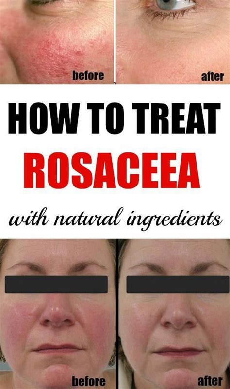 Pin On Rosacea Skin Care