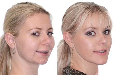 Corrective Jaw Surgery Complete Face Makeover Corrective Jaw Surgery