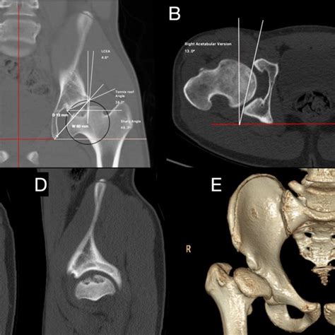Anteroposterior Pelvic Radiograph A And Axial View Of Both Hips B