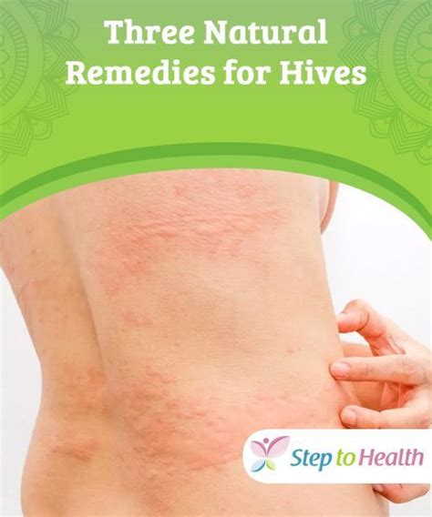 Three Natural Remedies For Hives If You Suffer From An Allergic