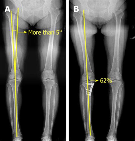 High Tibial Osteotomy With Human Umbilical Cord Blood Derived