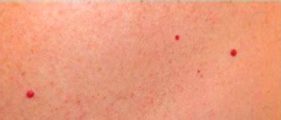 The initial symptoms of the acute myeloid leukemia are usually vague and not specific. tiny red spots on skin | Diabetes Go Away