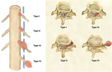 Frontiers Non Syndromic Spinal Schwannomas A Novel Classification