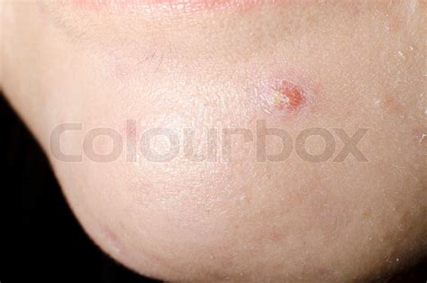 Chin Pimple Macro Stock Image Colourbox