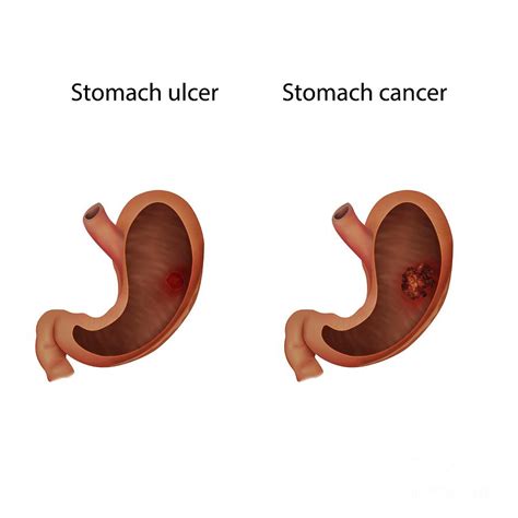 Stomach Ulcer And Stomach Cancer Photograph By Veronika Zakharovascience Photo Library