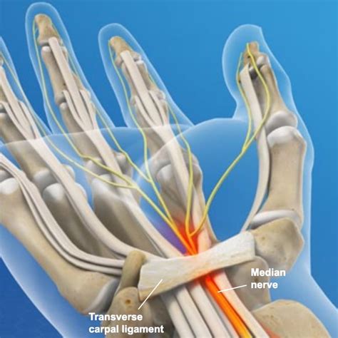 Carpal Tunnel Release Sierra Neurosurgery Group