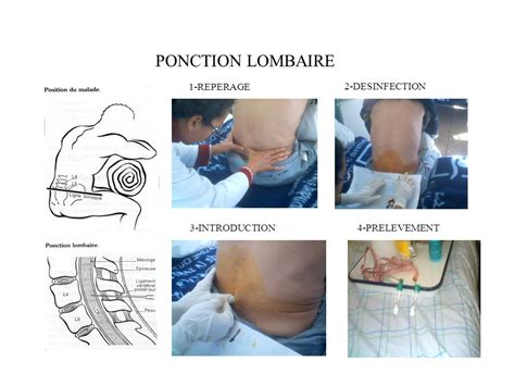 Ponction Lombaire