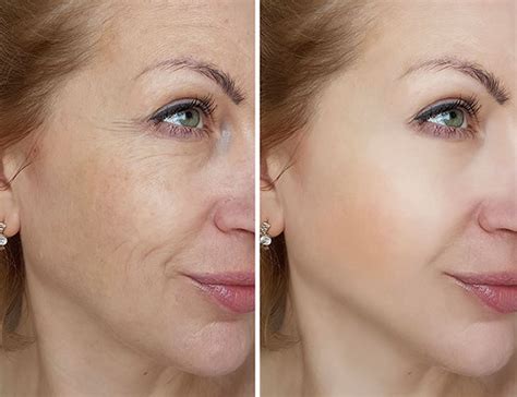 Know More About The Laser Skin Resurfacing Treatment Available Ideas