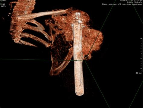 Ct Scan View Of Scapula And Proximal Humerus Invasion Download