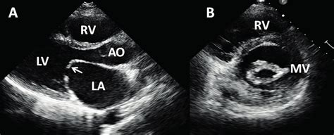 Transthoracic Echocardiography From Patient With Severe Mitral Stenosis