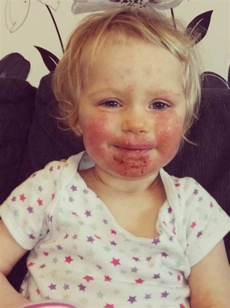Adorable Toddler Whose Face Was Eaten Alive By Herpes After Kissing