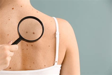 Tests for melanoma skin cancer. Who Should Get a Skin Cancer Check and How Often? : Rafael ...