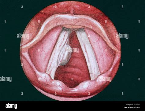 Diagram Vocal Cords With Sessile Polyp Stock Photo Alamy