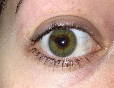 I Have A Brown Line Through The Green Of My Eye Also Known As Sectoral