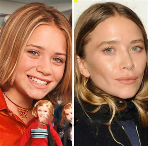 Mary Kate Olsen Plastic Surgery Nose Job Facelift Eyebrows