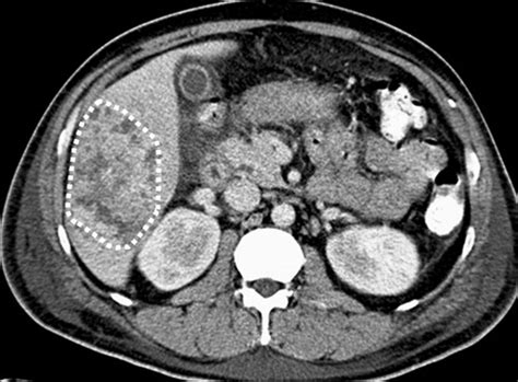 Ct Appearance Of Pyogenic Liver Abscesses Caused By Klebsiella