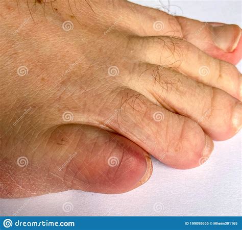 Discolored Broken Little Toe Of A Senior Man Stock Image Image Of