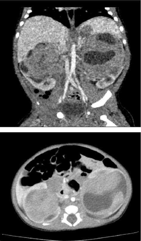 Congenital Bilateral Wilms Tumor A Case Report Urology