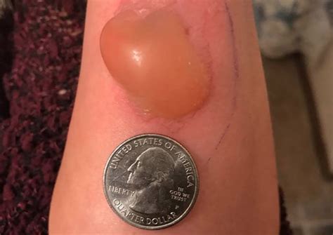 Michigan Woman Treated For Brown Recluse Spider Bite Cbs