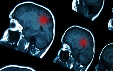 Are There Any Early Warning Signs Of Brain Tumors