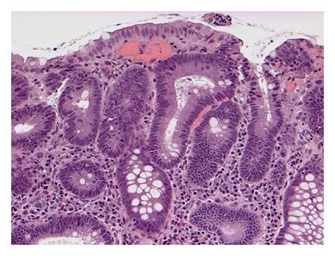 Melanosis Coli In Specimen With Tubular Adenoma A Melanosis Affects