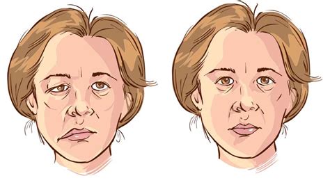 Facial Paralysis Symptoms Causes Treatments What Causes Facial