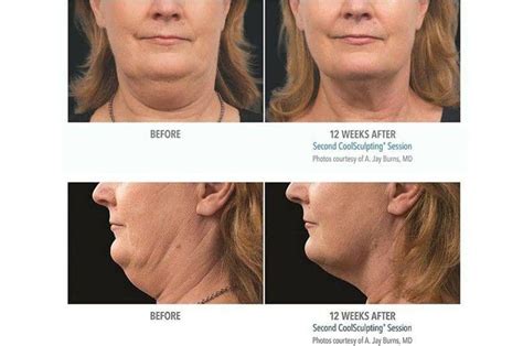 Chin Wars Coolsculpting® Vs Kybella® The Refinery Skin Clinic